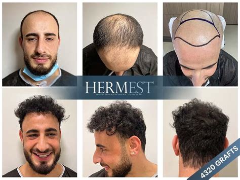 hermès turkey online store|hermest hair transplant clinic istanbul.